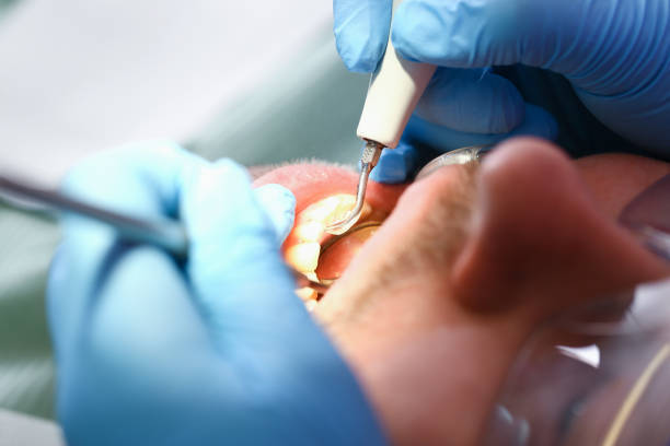 Best Knocked-Out Tooth (Avulsed Tooth) Treatment in Kraemer, LA
